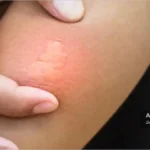 ایجاد التهاب با نیش زنبور