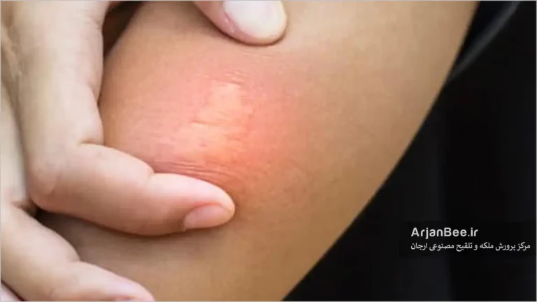 ایجاد التهاب با نیش زنبور